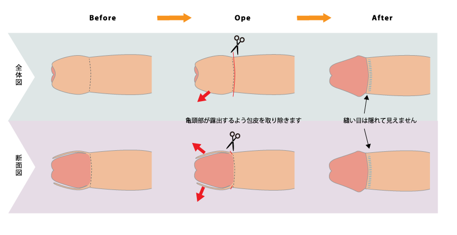 環状切除術の説明図